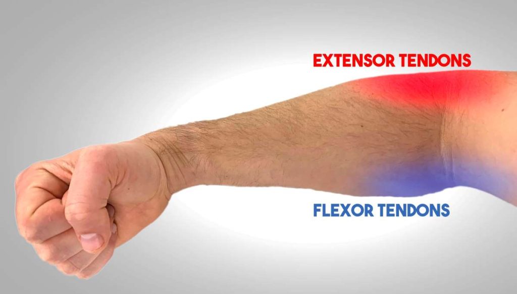 How Elbow Sleeves Can Help Your Tendonitis (and Which Ones to Wear ...