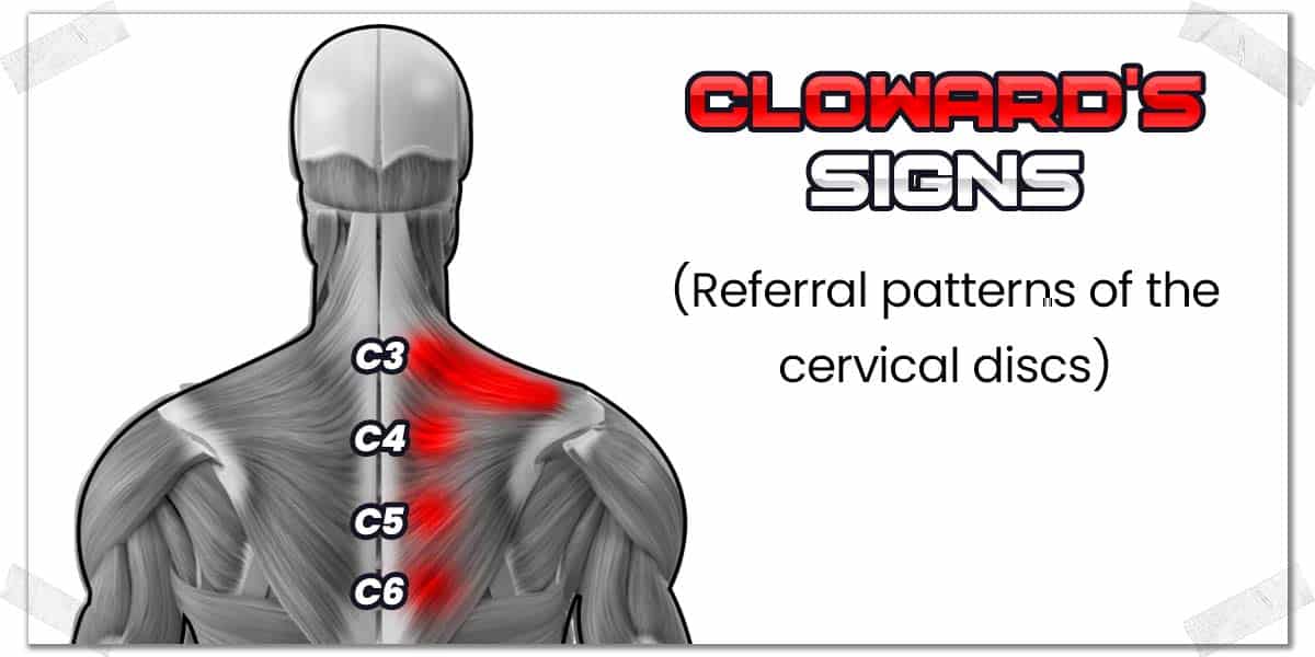 C4 Referral Pattern Neck Pain with the Bench Press | Causes | Solutions | A PT Explains ...